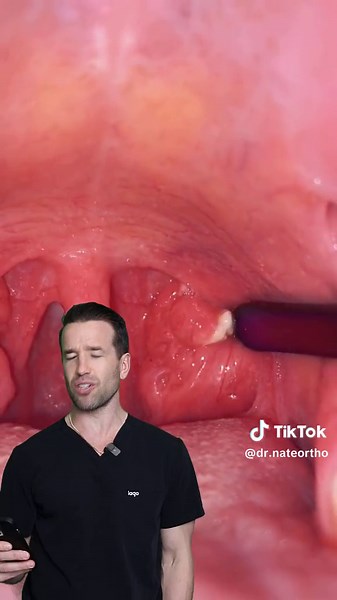 Tonsil stones. #tonsilstones #tonsilstonesremoval #tonsils #dentist #dentistreacts Vid cred @Tonsil Girl