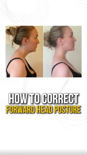 1M views · 12K reactions |  Forward Head Posture is Wrecking Your...