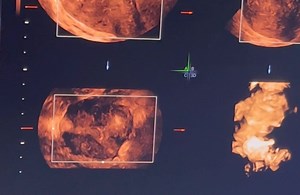36K views · 249 reactions | Uterine myoma, compressing one cornue creating filling defect in 3D image, to assess Myoma in this way is called myoma maping. It is very essential part before deciding surgery. | Dr Taslima Begum | Facebook