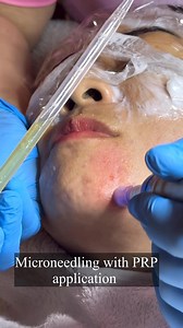 142K views · 1.1K reactions | Twin R Salon & Aesthetic Center- GenSan Branch Vampire Facial Treatment (PRP) ₱1500/session with Basic Facial Di ko na ramdam yung sakit- immune na ako  para sa mga acne scars, mga itim itim sa mukha, mga age lines and pimple dark marks- pa atake na na kayo! See you for 3rd session! | Tindera sa Africa | Facebook