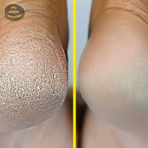 567K views · 1.9K reactions | How To Get Rid Of Cracked Heels. No More Cracked heels with this homemade cracked heels Home Remedy. | Simple Beauty Secrets | Facebook