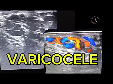 Ultrasound of varicocele.