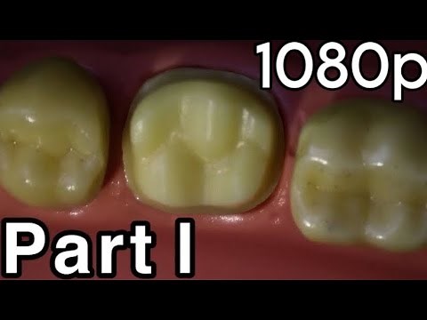 Full Metal Crown Preparation For Mandibular First Molar (Lower 6) (Part 1 Occlusal Reduction)