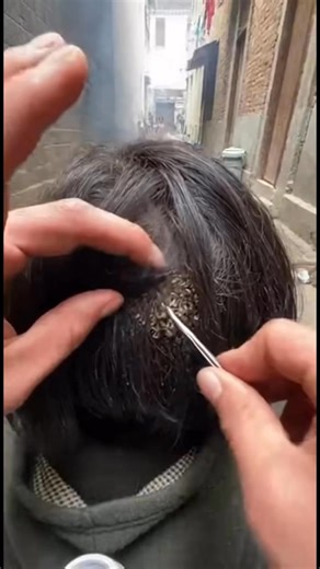 Ticks | Extreme tick infestation found. This video is for hygiene awareness and prevention only. Safe demonstration no medical advice. #ticks... | Instagram