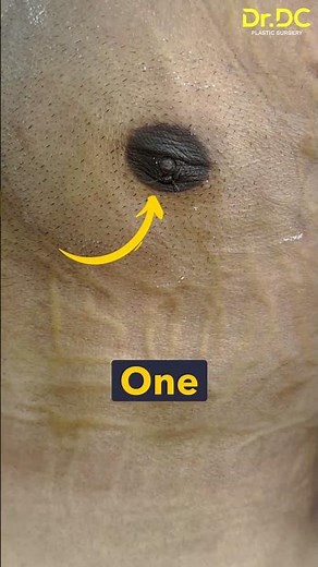 Gyno: Real Patient Result After Gynecomastia Surgery | See the Actual Recovery Process! | Dr DC Pune