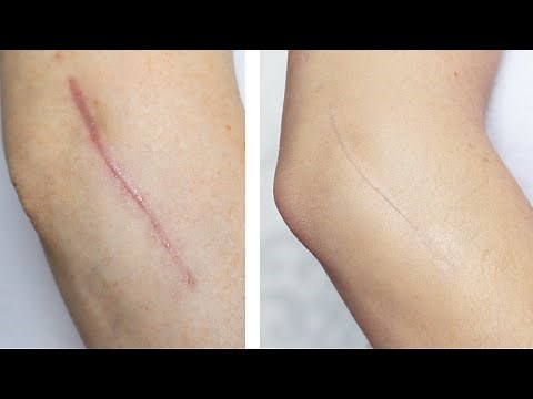 How To: Cover / Conceal A Scar