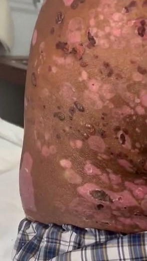 Demonstration of Asboe hansen sign in case of bullous pemphigoid.