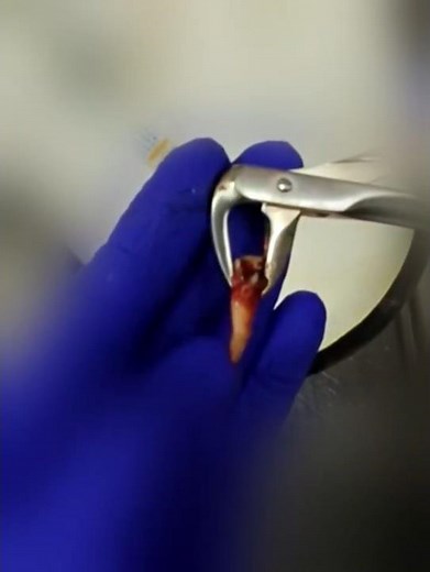 Extraction of the First Molar and the Second Premolar on the Right Side ‪@DentistPOV‬