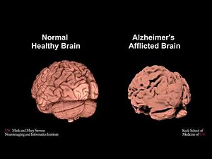 Normal and Alzheimer's brains dataset comparison.