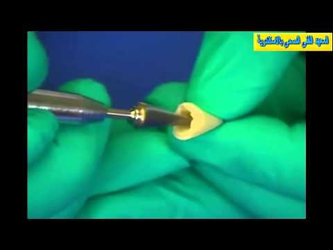 Polycarbonate Temporary Crown