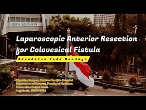 Laparoscopic Anterior Resection For Colovesical Fistula