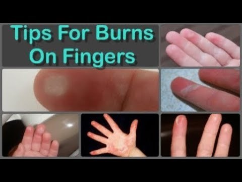 How To Cure Finger Burns And Home Remedies for Burns on Fingers Naturally