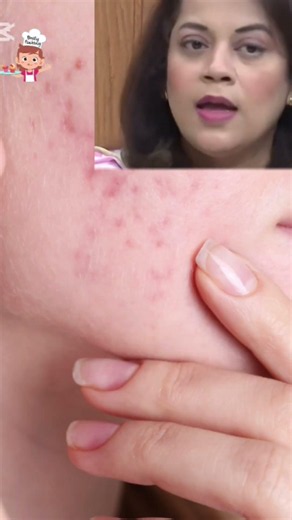 Best Home Remedy for Heat Rashes and Tiny Bumps on Skin ? #skincaretips#HeatRashRemedy@KunFoods