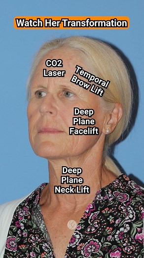 4.9K views · 46 reactions | Her Results Though 朗Vertical Facelift is...