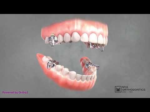 How MARA Works | Fixed Functional Appliance for Class II Correction