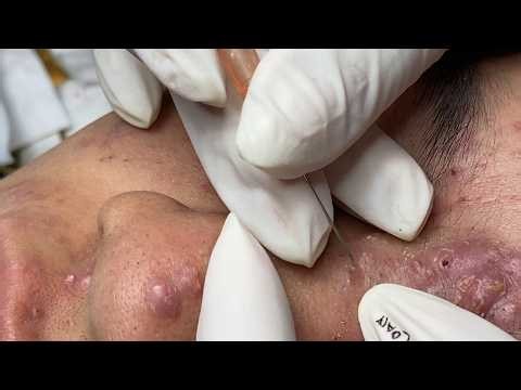 Blackhead Removal for Office Men | Loan Nguyen Acne Treatment Official