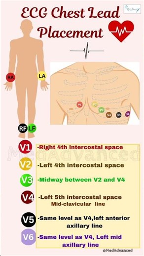 ECG Chest Lead Placement (V1–V6) | Easy & Accurate Guide