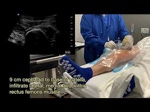 Out-patient TKA - Nerve Blocks and U/S-guided Local Infiltration Analgesia by Anesthesiologists