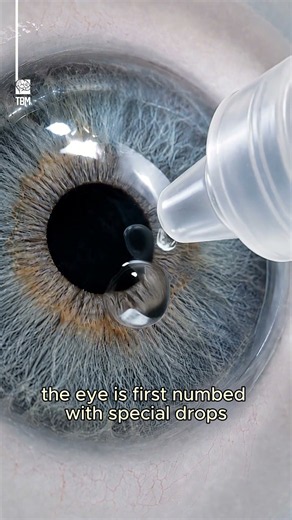 Cataract Surgery Explained