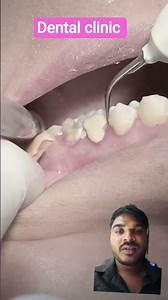 Scaling heavy calculus and tartar of teeth#satisfying