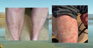 Health officials warn of 'swimmer's itch' in Utah lakes and ponds