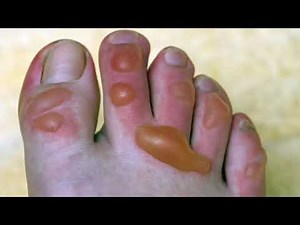 Your Feet & Diabetes