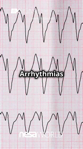 Arrhythmias, the Autonomic Nervous System, and Sleep Quality 🔄 The Nervous System’s Role: The autonomic nervous system (ANS) is like a conductor, orchestrating the heart’s rhythm. When the balance tips—too much sympathetic drive or not enough parasympathetic calm—arrhythmias can arise, disrupting this harmony (Zipes & Jalife, 2019). 🎼 👉 Sleep and the Heart’s Rhythm: Poor sleep, especially from disorders like sleep apnea, can intensify sympathetic activity and diminish vagal tone, setting the 