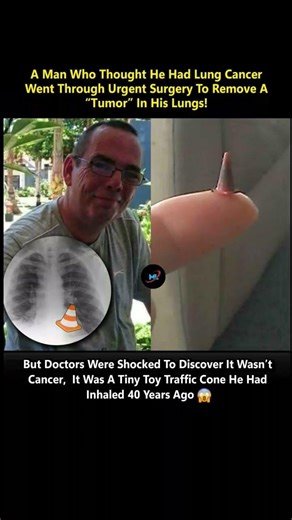 During a bronchoscopy, surgeons found the 1 cm plastic toy instead of cancer.