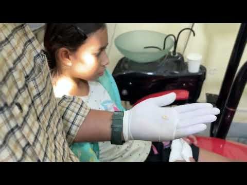 Extraction of Deciduous tooth (Milk Tooth)