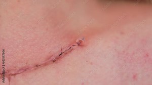 Scar after thyroidectomy. Surgical removal of the thyroid gland.