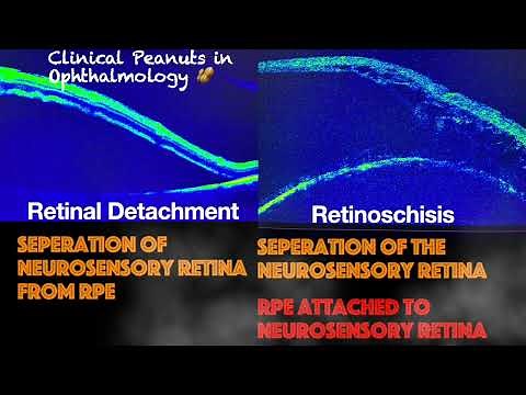 Retinoschisis Vs Retinal Detachment