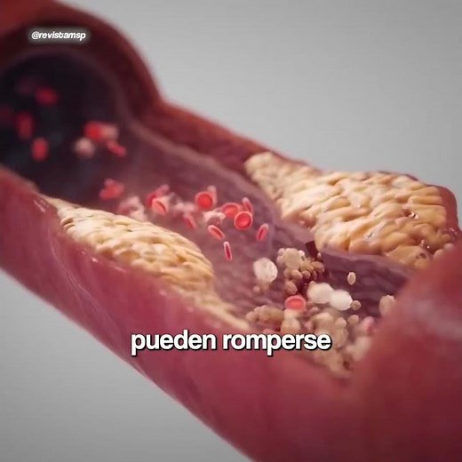 Accidente cerebrovascular isquémico