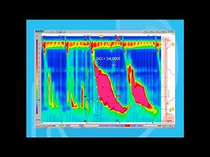 Esophageal Motility Disorders Part 2