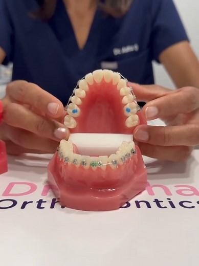 Understanding Bite Blocks in Orthodontics