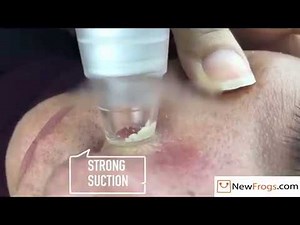 Blackhead Cleaning Removal Tool Pore And Pimples Suction Device Vacuum