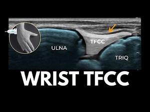 WRIST TFCC - MSK Ultrasound Snapshot