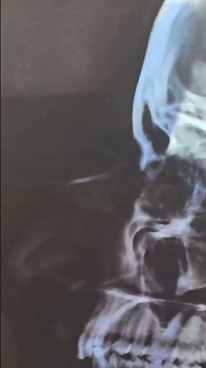 X Ray Showing Nasal Bone Fracture #anesthesia #lifeisbutadream #doctor