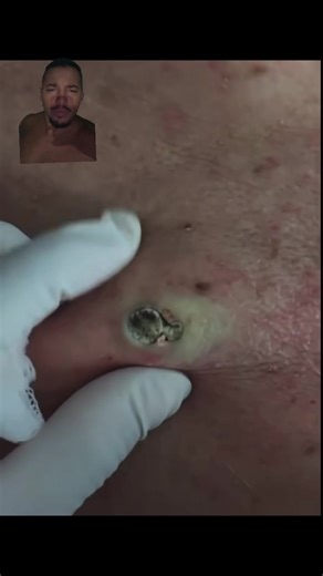 Cravo Gigante (Comedão) Na dermatologia, um