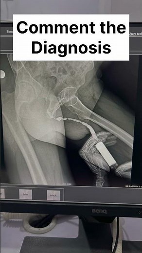 RGU Oblique Views – What Is the Diagnosis?#shorts