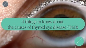 4 things to know about the causes of thyroid eye disease (TED)