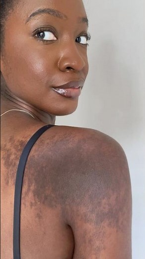 Tattoo, Scar, Bruise Need A Cover Up?