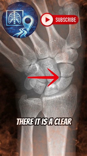 This Wrist X-Ray Looks Normal… Until You Use the Scaphoid View #radiology #shorts