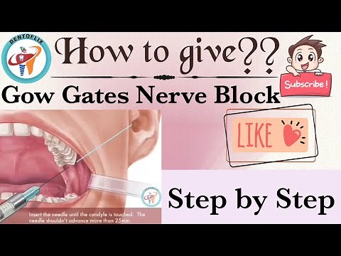 How to give Gow Gates Nerve Block || Oral Surgery