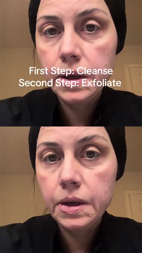 Exfoliating with a skin razor (dermaplaning) gently removes dead skin cells and peach fuzz from the surface of the skin, revealing a smoother, brighter complexion instantly. This treatment helps skincare absorb better, allows makeup to glide on flawlessly, and can improve the appearance of dullness and uneven texture. When done correctly on clean, dry skin with light strokes, dermaplaning is a safe, non-invasive way to refresh the skin—without making hair grow back thicker or darker. Best for mo