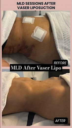 Manual Lymphatic Drainage After Vaser Liposuction | Before & After Recovery Results