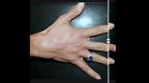 Restylane Lyft is the first and only FDA approved hyaluronic acid filler for injection into the hands