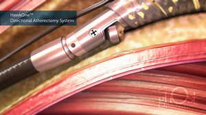 Ghost Productions - Medtronic - HawkOne