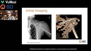 Application and Clinical Experience of Arista AH MPH in Upper Extremity Fracture and Shoulder Arthroplasty Procedures
