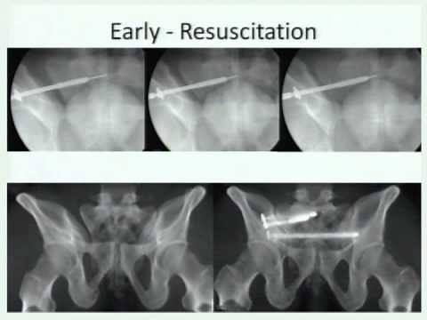 Update: Pelvis Fractures