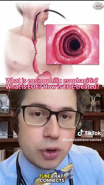 What is eosinophilic esophagitis? What is EOE? How is EOE treated? For general educational purposes only. #eoe #food #allergies #tiktokdoc #LearnOnTikTok #usa